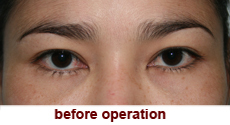 plastic-surgery-blepharoplasty